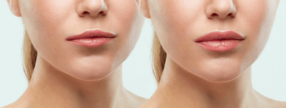 which filler is best which filler is best
