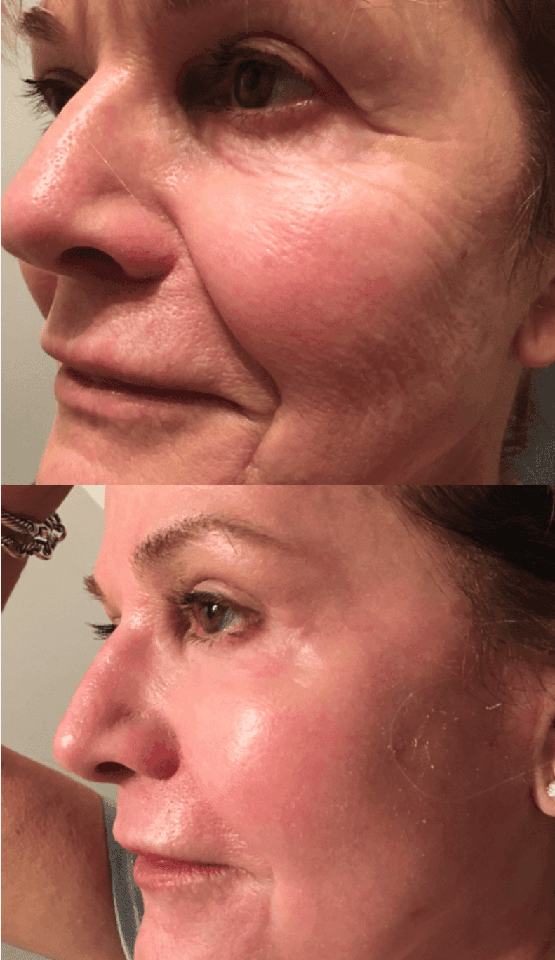 Mask-Group-4-1 Skin resurfacing