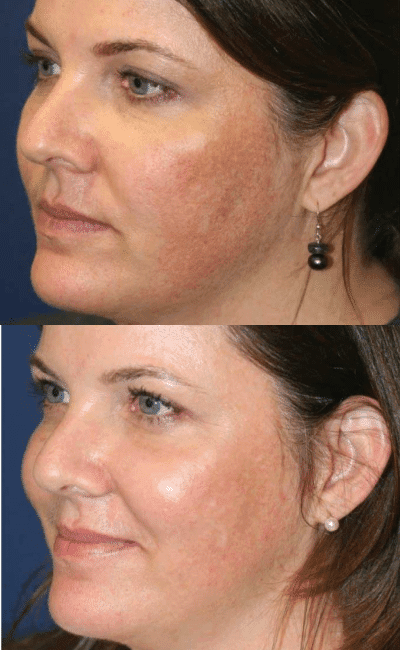 Mask-group-9 CO2 Laser Resurfacing