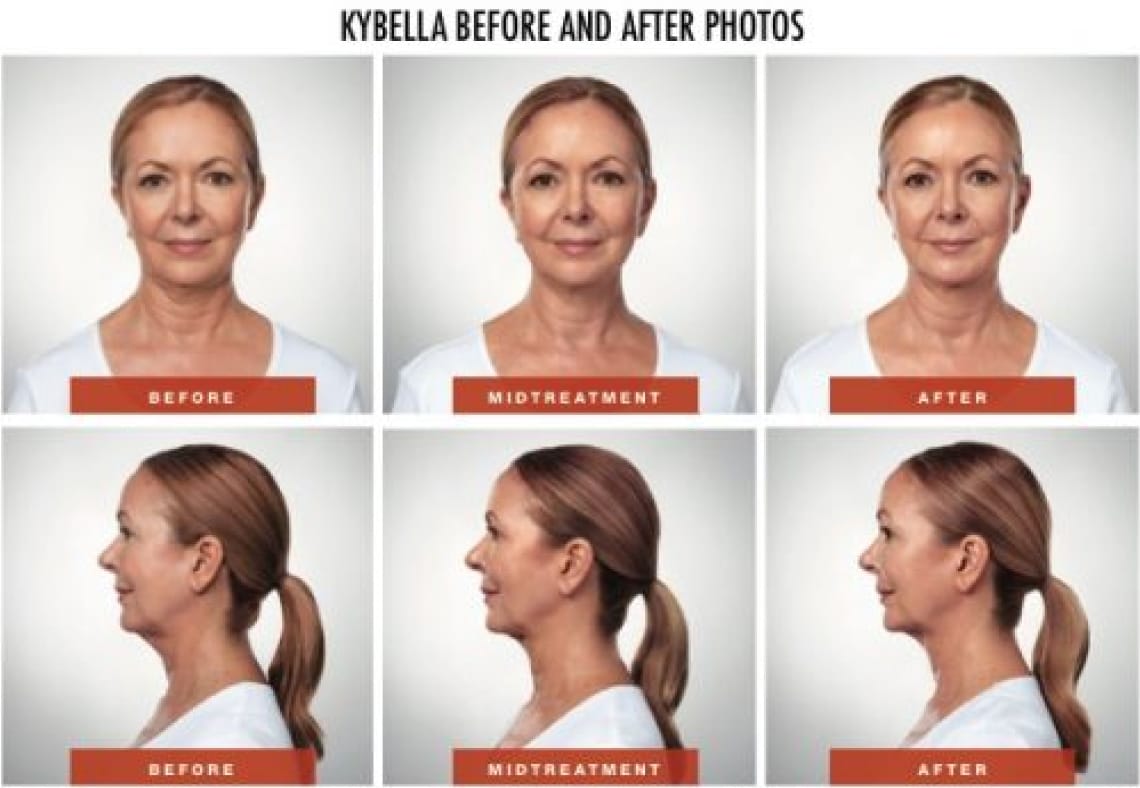 kybella-before-after-img kybella-before-after-img