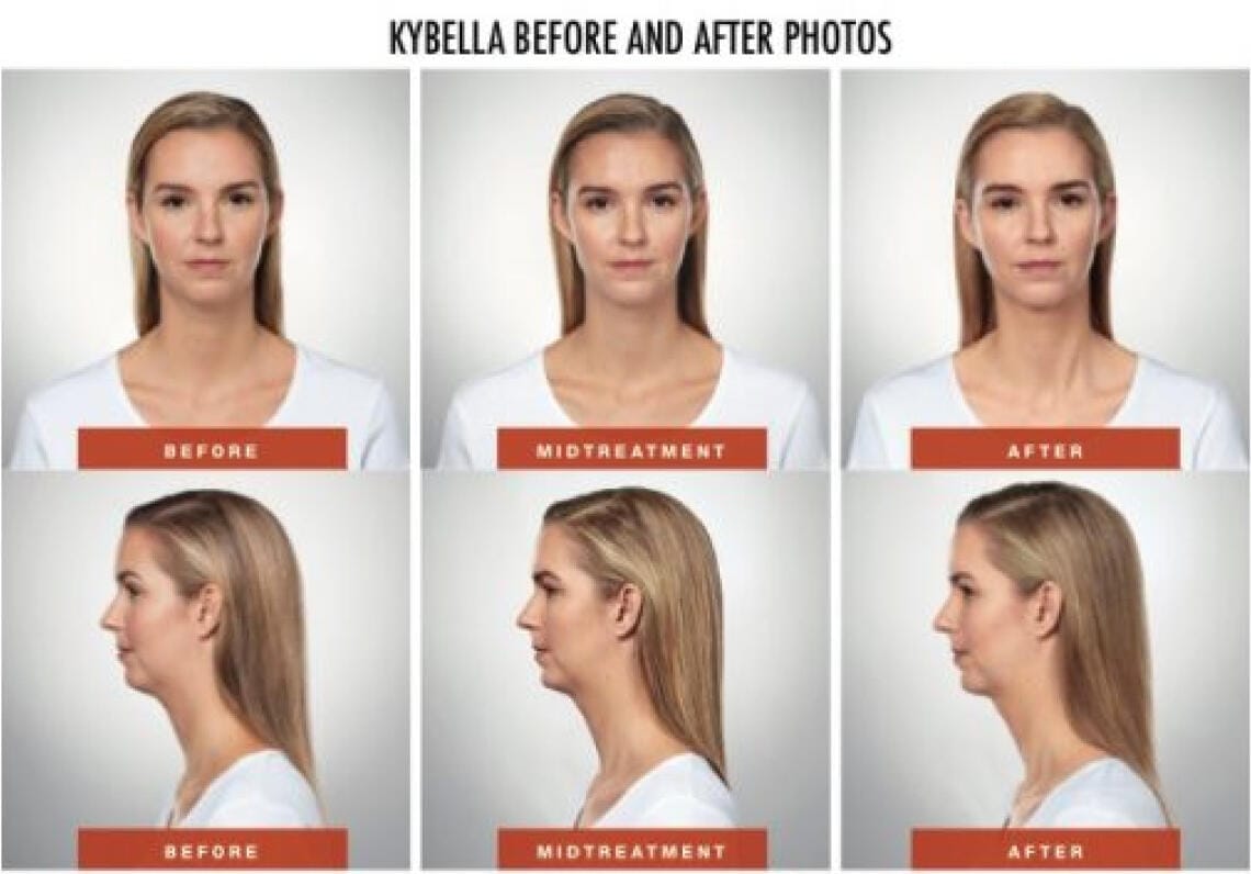 kybella-before-and-after-photos kybella-before-and-after-photos