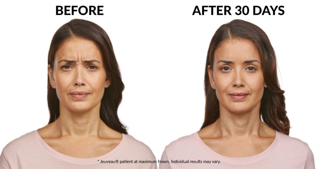 Jeuveau Before-after