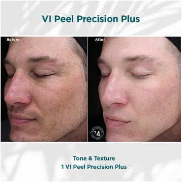 Tone-Texture Tone Texture Vi Peel