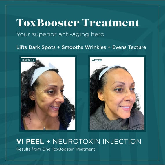 Toxbooster-B_A Toxbooster Treatment Vi Peel
