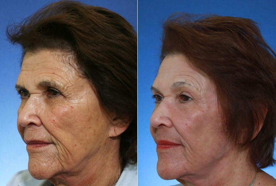 Jeuveau Before-after