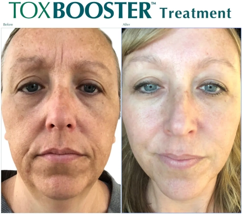 ToxBooster Treatment