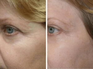 Xeomin-In-Alpharetta-GA-FST-img Xeomin-In-Alpharetta-GA-FST-img
