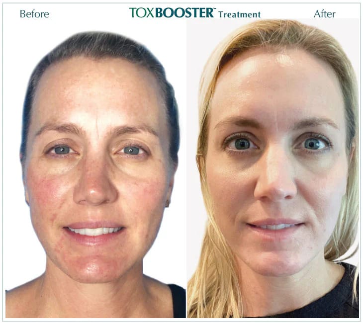 ezgif.com-webp-to-jpg-converter (8) ToxBooster Treatment