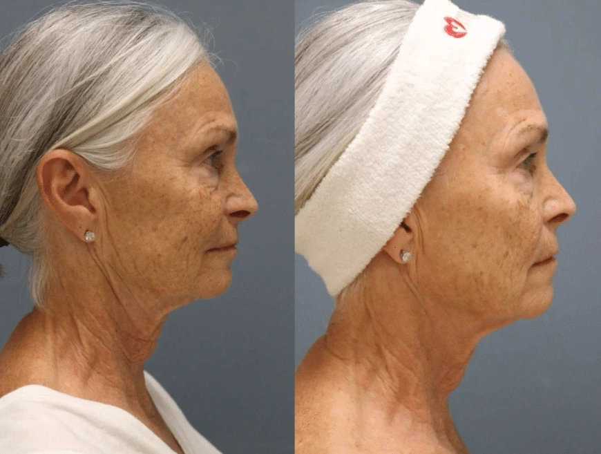 rf-microneedling-pricing- rf-microneedling-pricing-
