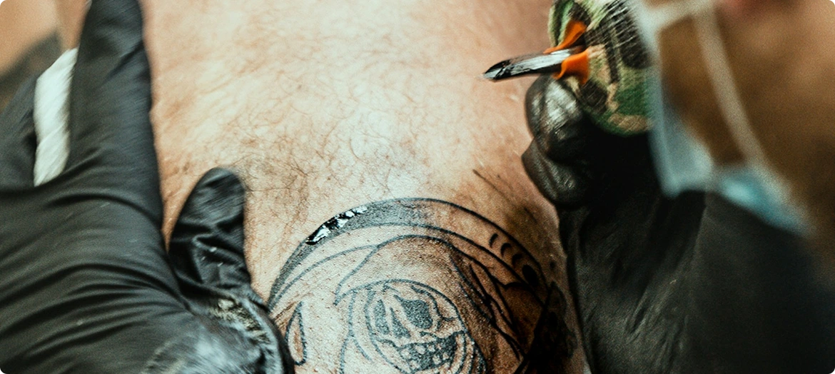 Laser Tattoo Removal img Laser Tattoo Removal img