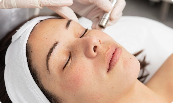 CO2 Laser Resurfacing img