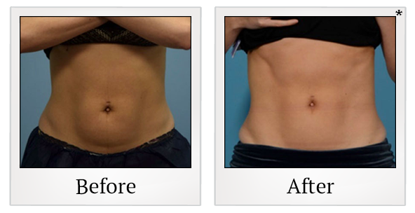 body-tone-treatment-ba-1 Body Sculp in 250 dollar