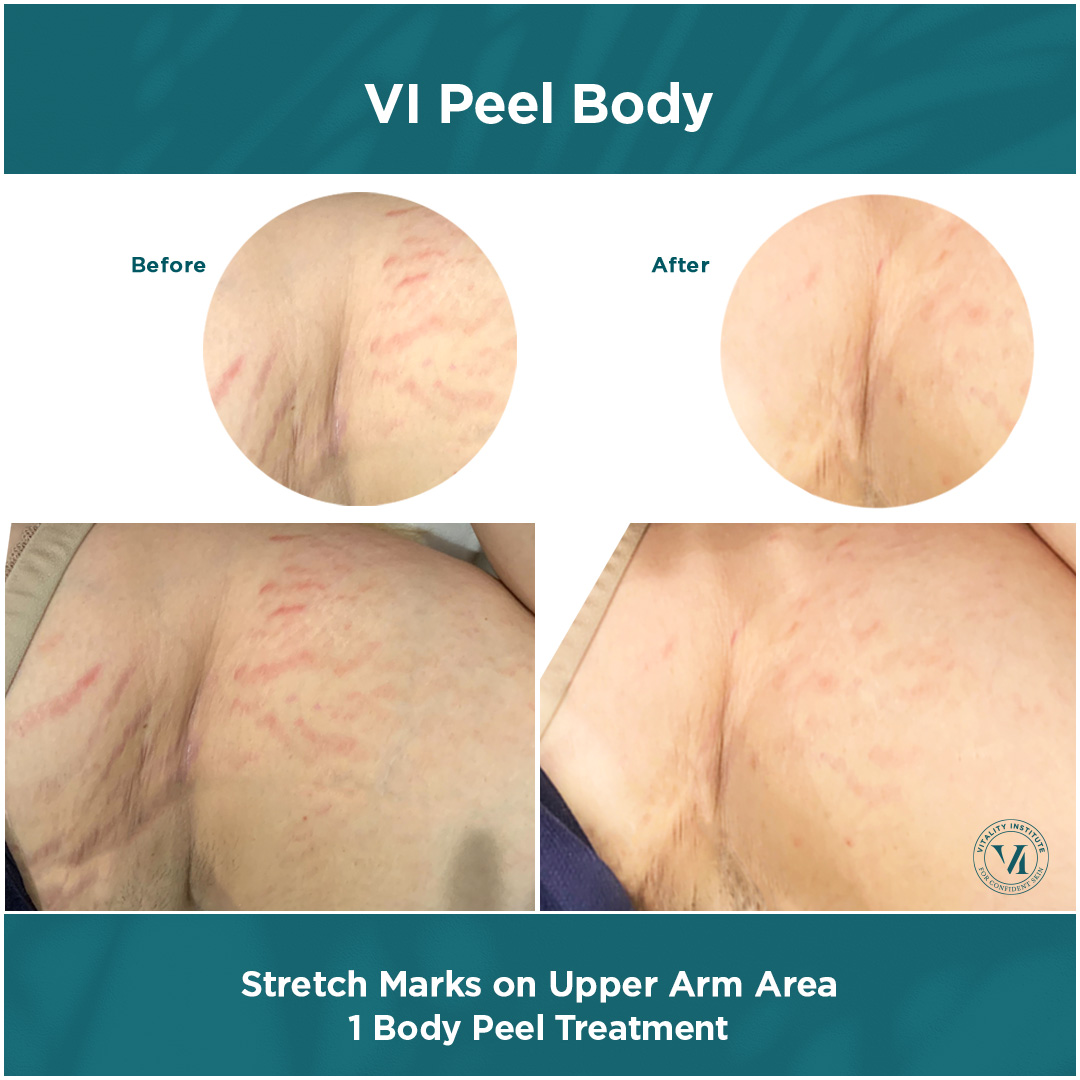 vi peel body Stretch-Marks-on-Upper-Arm ToxBooster Treatment