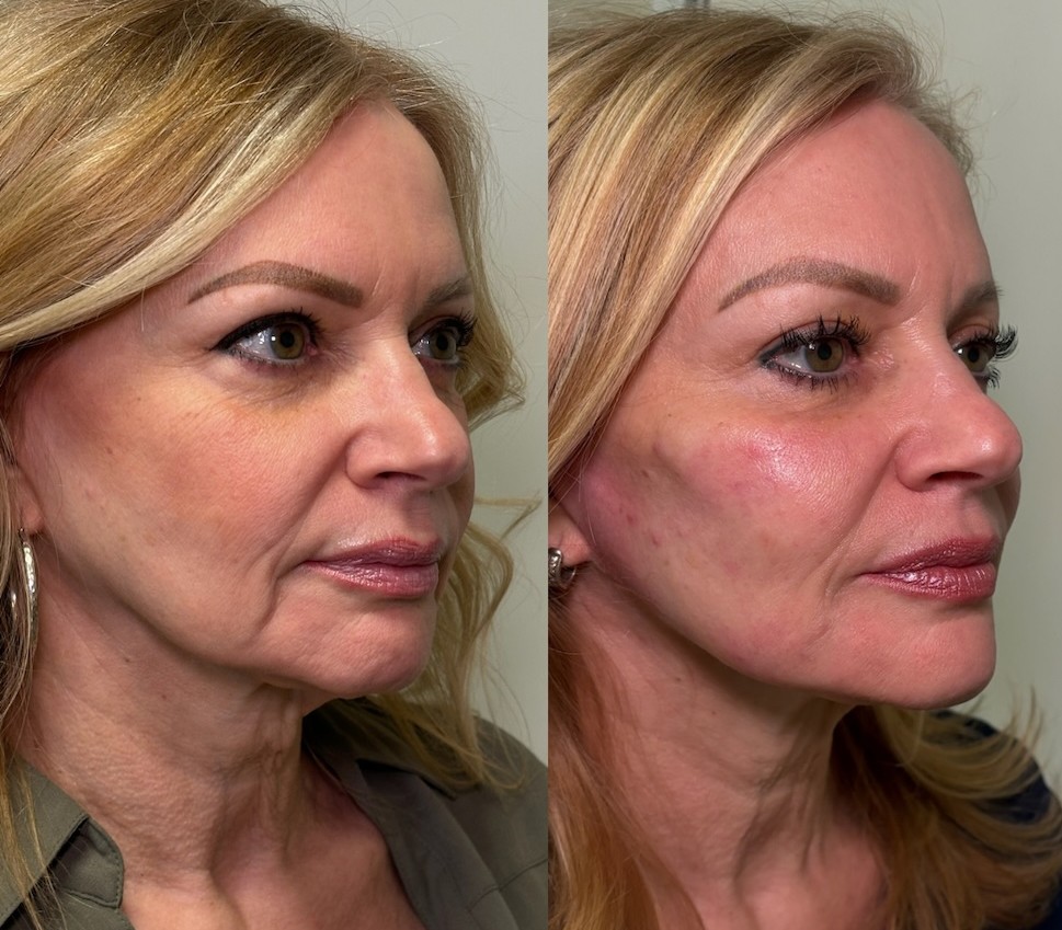 Body Sculp in 250 dollar