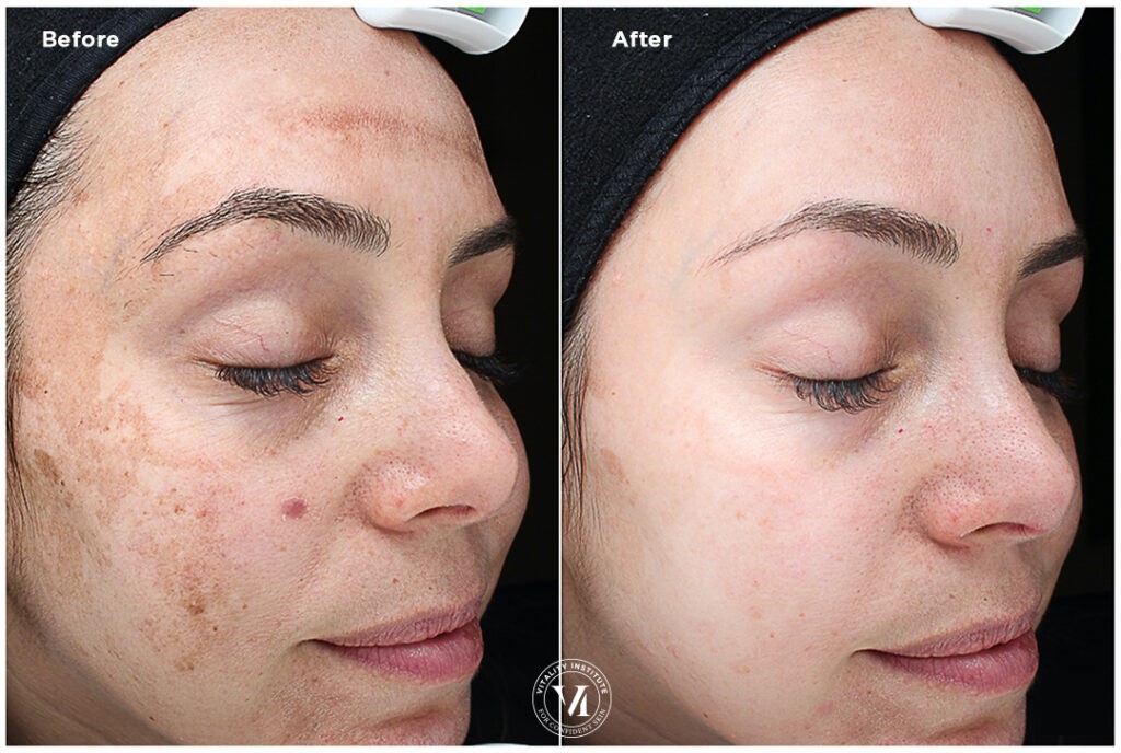 Melasma_3-VI-Peel ToxBooster Treatment
