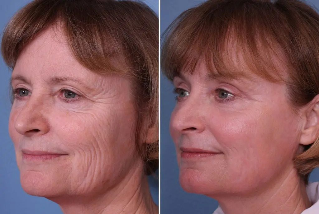 Jeuveau Before-after
