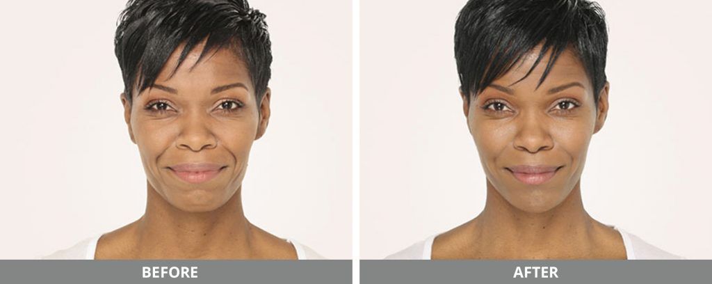 Radiesse_b&a Jeuveau Before-after
